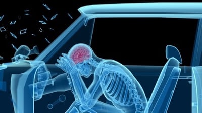 Head Injury After a Car Accident 