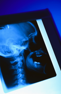 X-Ray of Accident Injury