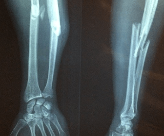 Broken bone slip and fall accident