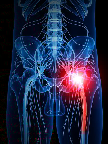 Sciatic Nerve Pain Relief